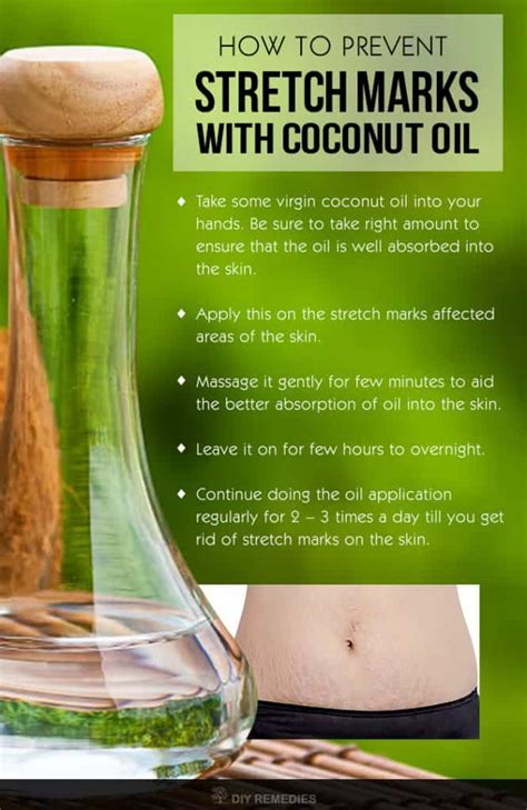 Can coconut oil prevent stretch marks during pregnancy